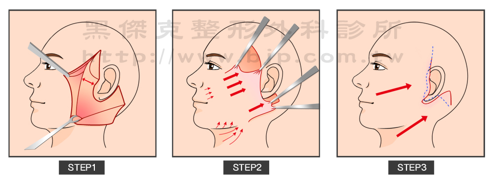 中下臉拉皮手術傷口沿著耳前至耳後，將鬆弛的皮膚進行剝離，將造成鬆弛的筋膜組織做緊實的拉提後，再將多餘的皮膚切除縫合，以改善中下臉部的鬆弛度和皺紋深度。