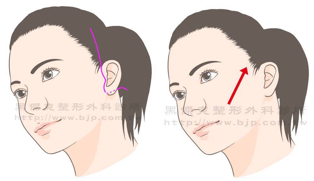 內視鏡中臉拉皮手術，可改善臉部鬆弛度和皺紋深度，方法之一可在耳朵上開一個約2~3公分切口，以懸吊法將中臉肌肉筋膜向上懸掛在兩顳側的深肌膜