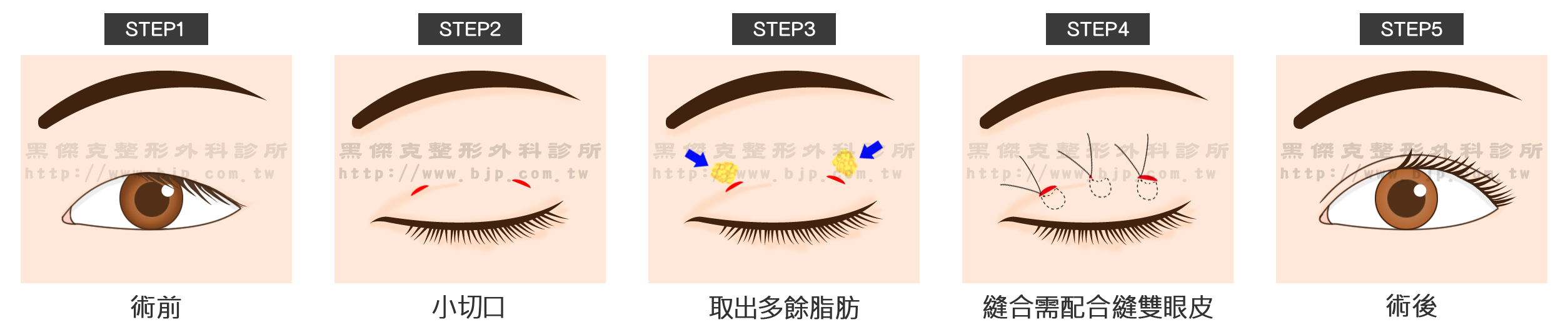 割雙眼皮手術,是在上眼瞼上做一個切口,從傷口上創造一個漂亮褶線線條。同時可以改善外觀條件(如移除適量眼眶脂肪等),然後再將表皮傷口縫起來。