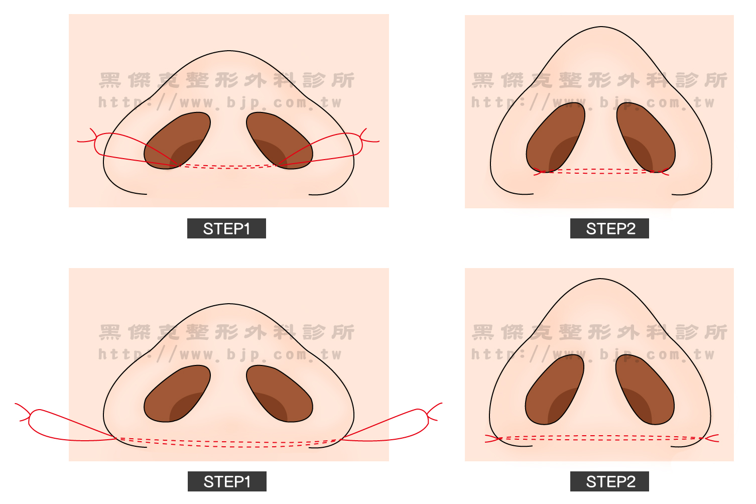 寬鼻翼矯正手術,透過由鼻孔內(鼻翼內側)將部分的鼻肉組織切除後，在以縫線穿越鼻中柱底部將兩邊鼻翼往中間固定，即可達到將鼻翼往內收效果，鼻孔也可以同時縮小。