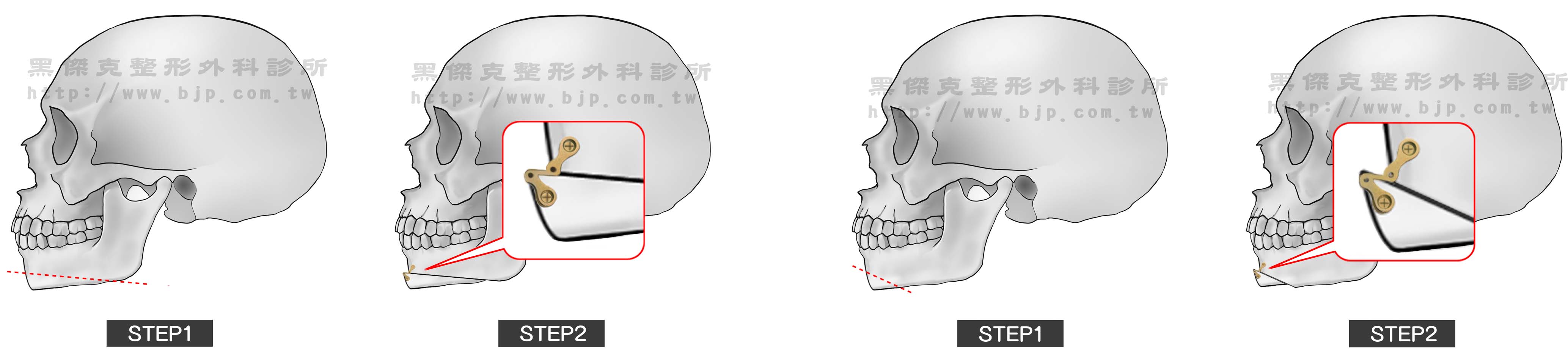 下巴截骨術,把下巴骨(下頷骨)橫向切開,將下巴骨下半段向前移位來增加下巴突出,以金屬骨釘和骨板固定後,使下巴骨於新位置癒合,達到改正下巴後縮的效果。