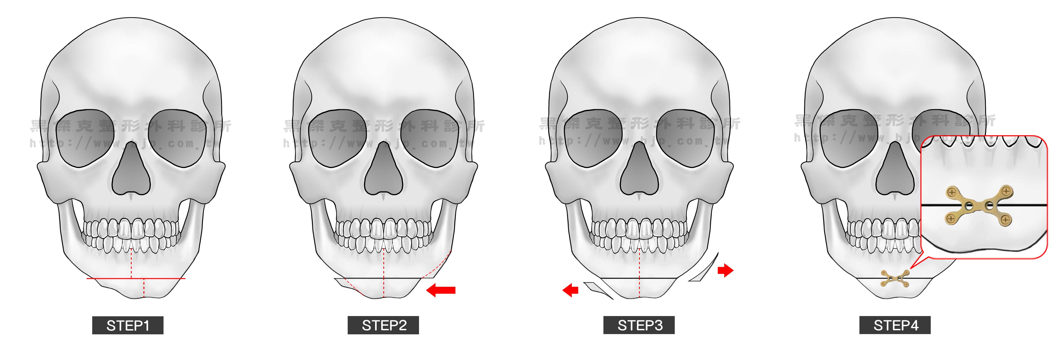 下巴歪斜，輕微的下巴歪斜可用下巴手術改善矯正，較複雜的則需用正顎手術及臉骨塑型來達到改善。