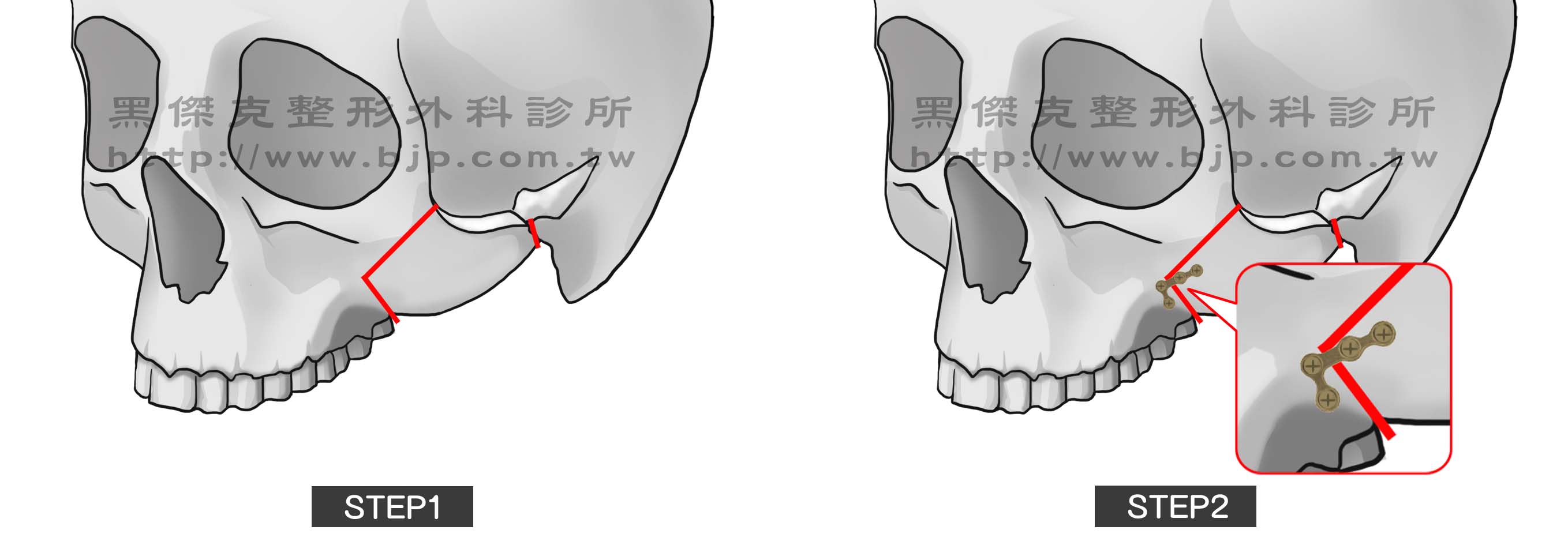 顴骨磨骨手術，輕度的顴骨縮減術，切口位在口腔內上牙齦旁，只做顴骨體磨骨以減小顴骨體積，可改善顴骨太寬、凸出，和45度角側臉輪廓的弧度。
