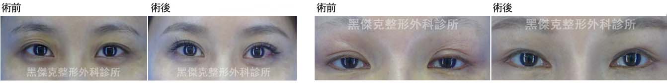 上眼皮重修手術，成功的上眼皮手術，涵蓋著形狀、皮膚厚度質感、摺痕高度及流暢性。