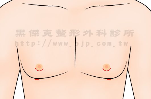 男性女乳症，乳腺切除：以手術切除，從乳暈旁的切口，把部分乳腺組織切除，使乳房外觀變得較為平坦，但仍必須保留部分乳腺組織，以防術後造成凹陷。