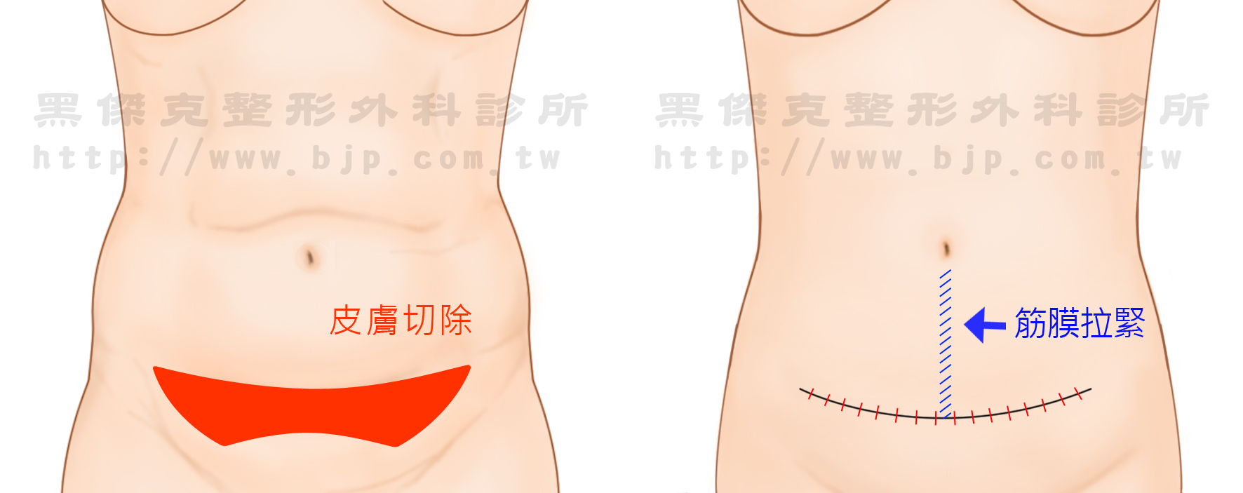 下腹部拉皮，將鬆弛的腹部肌肉和筋膜拉緊，切除多餘的皮膚，亦可同時合併加上抽脂手術。