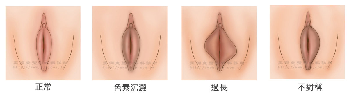 小陰唇整形手術，透過手術將小陰唇外緣多餘、肥厚或顏色較深的組織切除，修整成小巧可愛的模樣，手術後無需拆線，大約兩週縫線會自動脫落。