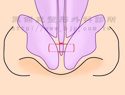 蒜頭鼻矯正手術,適用於大部分多數鼻孔又圓又大或是鼻翼明顯外擴的受術者。其手術方式就是在將過多的鼻翼組織從鼻孔內緣至鼻翼角外援做切除。