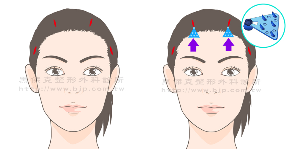 內視鏡前額拉皮手術，相對於一般的前額拉皮手術，是一種傷口較小的微創手術，在頭頂上方及兩側髮線後，左右共四個各約2公分長的傷口