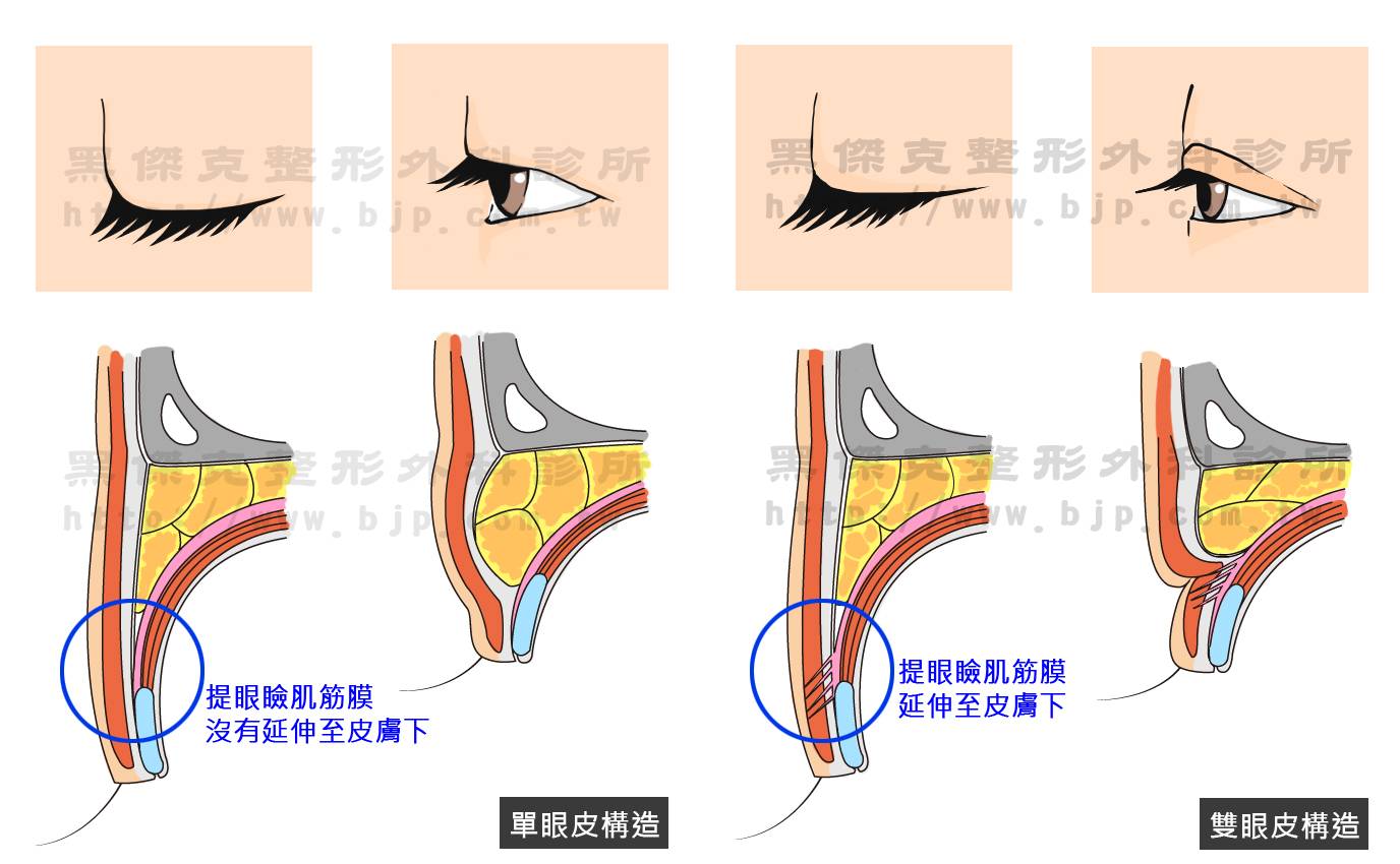 縫雙眼皮手術,透過雙眼皮手術縫線,在上眼皮埋入二個線口進行縫合,加強眼皮皺褶深度,營造出自然深邃的雙眼皮。