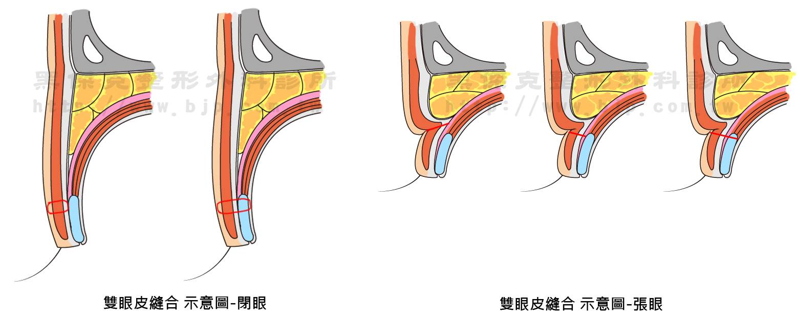 縫雙眼皮,適合於眼皮薄、皮膚無鬆弛的、年輕的族群。手術優點恢復迅速、效果自然、術後腫脹不明顯。