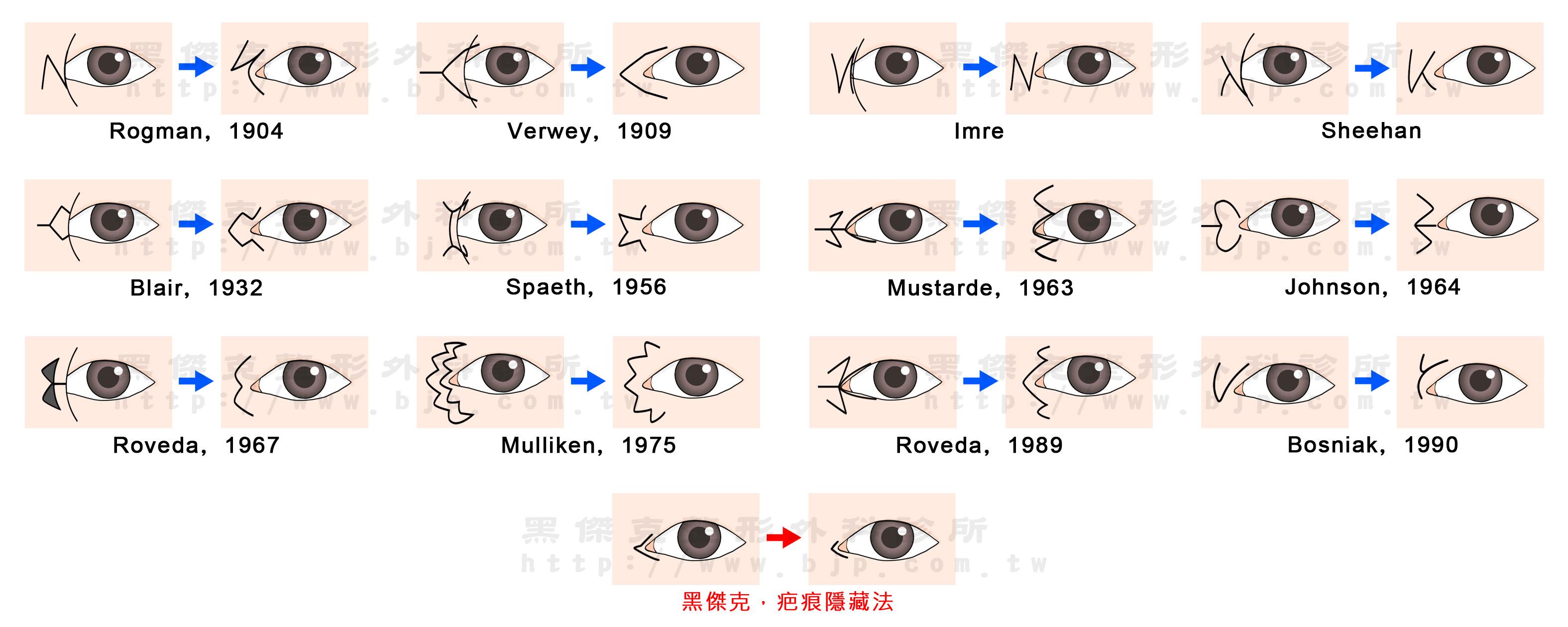 開眼頭手術,將多餘的上眼皮皮膚修剪移除,運用將疤痕隱藏在眼頭與眼皮交界處,讓原本隱藏的淚阜顯現出來。