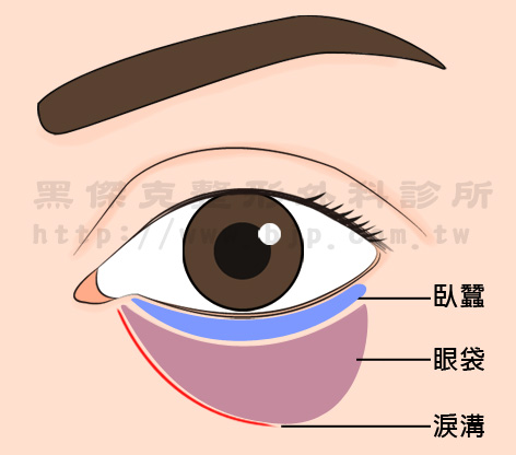 眼袋內開手術,適合年輕族群、眼袋症狀輕微者。手術於下眼瞼內側切出小切口(約5mm),撥開筋膜層後,再將多餘的脂肪分離去除。手術優點是在外表看不出切口、不須縫合拆線、恢復期短