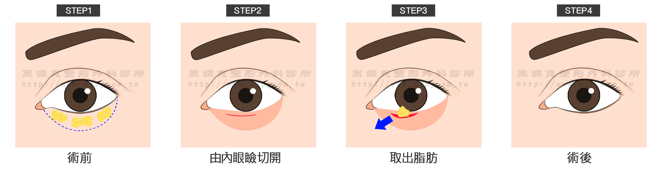 眼袋內開手術,不需拆線,傷口位置在內側結膜上,外表是看不見的。