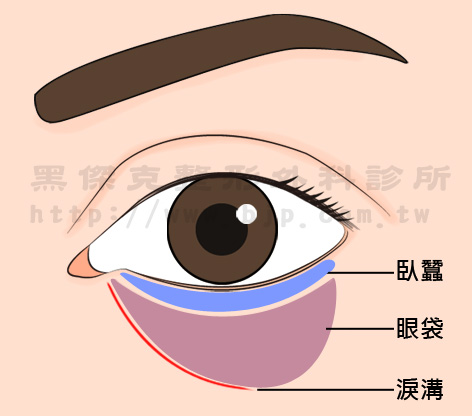 淚溝為內眼角靠近鼻側的凹溝線條，是因眼眶隔膜下緣的軟組織萎縮、下垂而形成，有些甚至延伸至中臉組織凹陷。