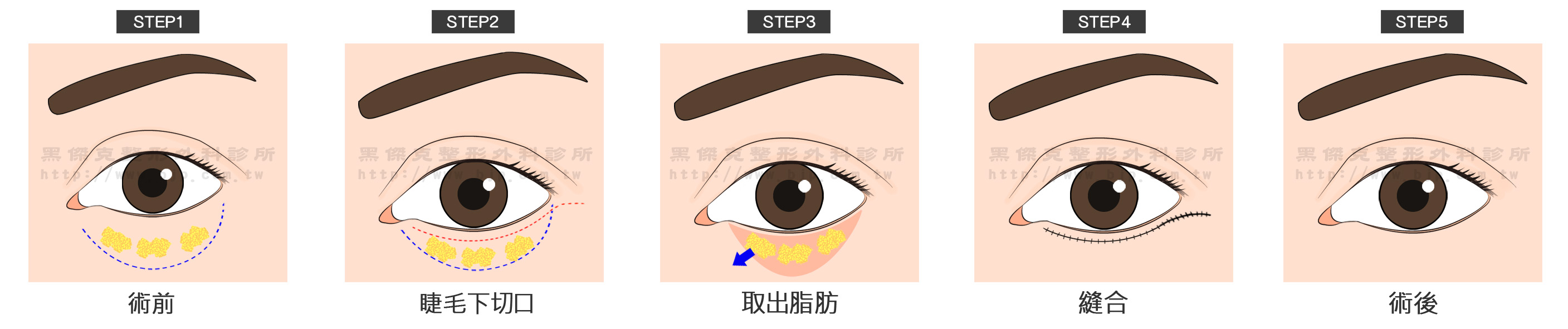 眼袋外開手術，是透過位於下眼皮睫毛下方的切口，拉緊鬆弛的眼皮、移除過多脂肪以及其他步驟，來改善下眼皮的老化現象。