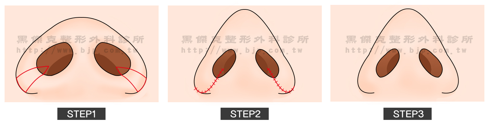 鼻翼鼻孔整形手術的切口都在鼻翼唇溝內外緣，這種手術常需搭配隆鼻或是鼻頭手術，以分層打造的概念達到鼻子整體的美感，即所謂「結構式隆鼻」。術後一般無明顯腫脹，大部分的疤痕並不明顯