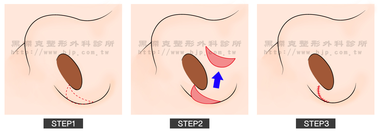 寬鼻翼矯正手術,手術優點是疤痕隱藏於鼻孔內不易被人察覺,手術恢復也快