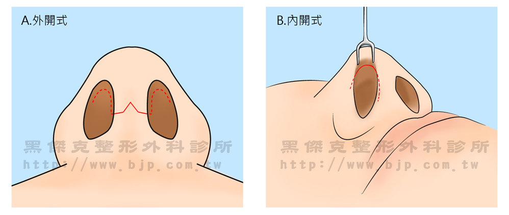 台中隆鼻手術方式分為外開式及內開式。