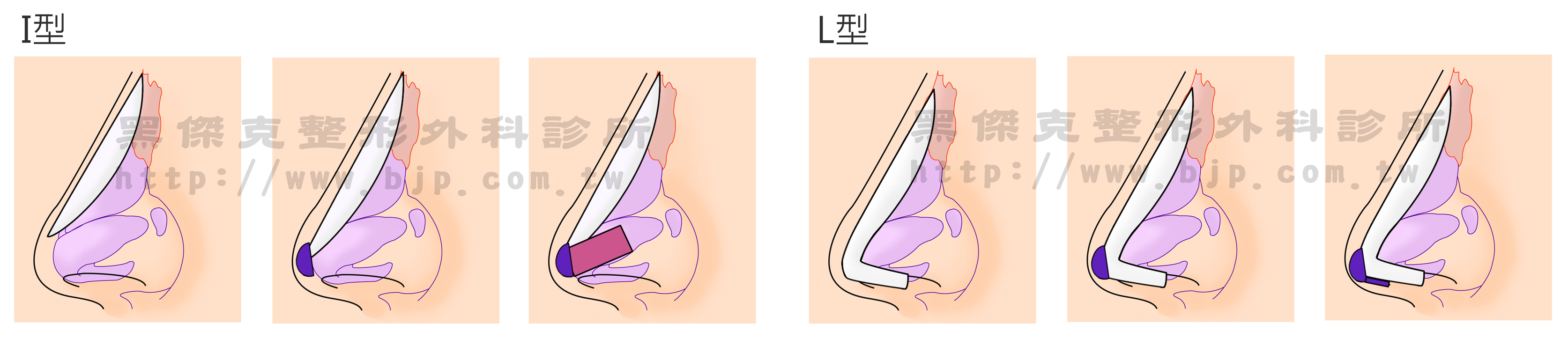 I型及L型台中隆鼻，黑傑克整形外科診所