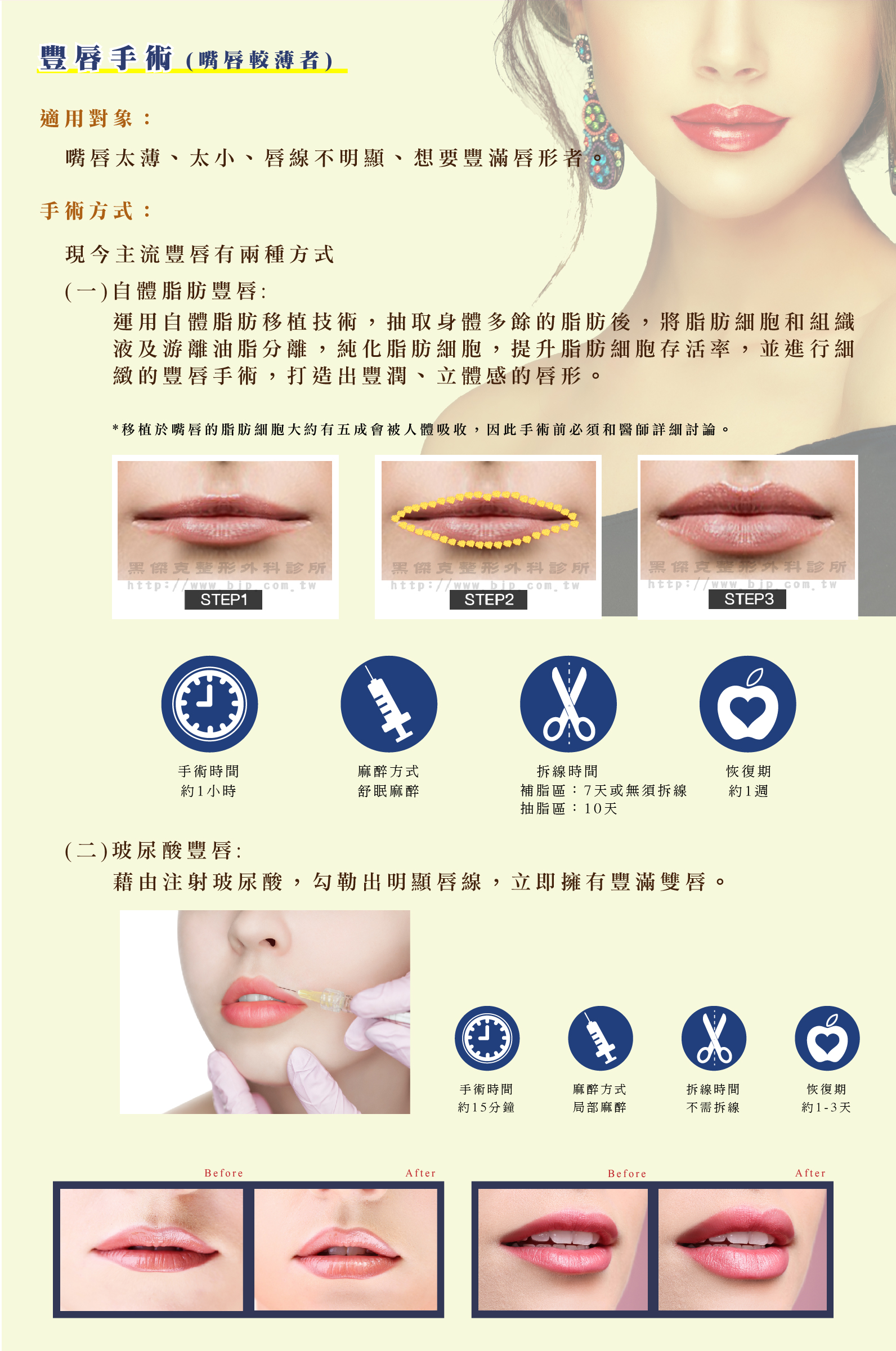 玻尿酸豐唇：藉由注射玻尿酸，勾勒出明顯唇線，立即擁有豐滿雙唇。