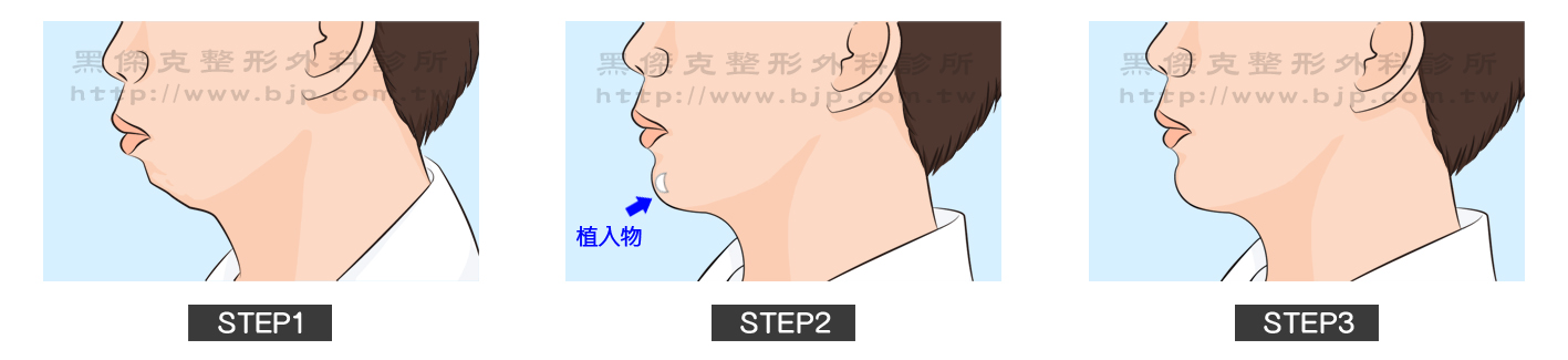 墊下巴手術，手術是由下唇的口內深處黏膜作切口，依不同臉型需求，將植入物適度雕刻後放入固定。