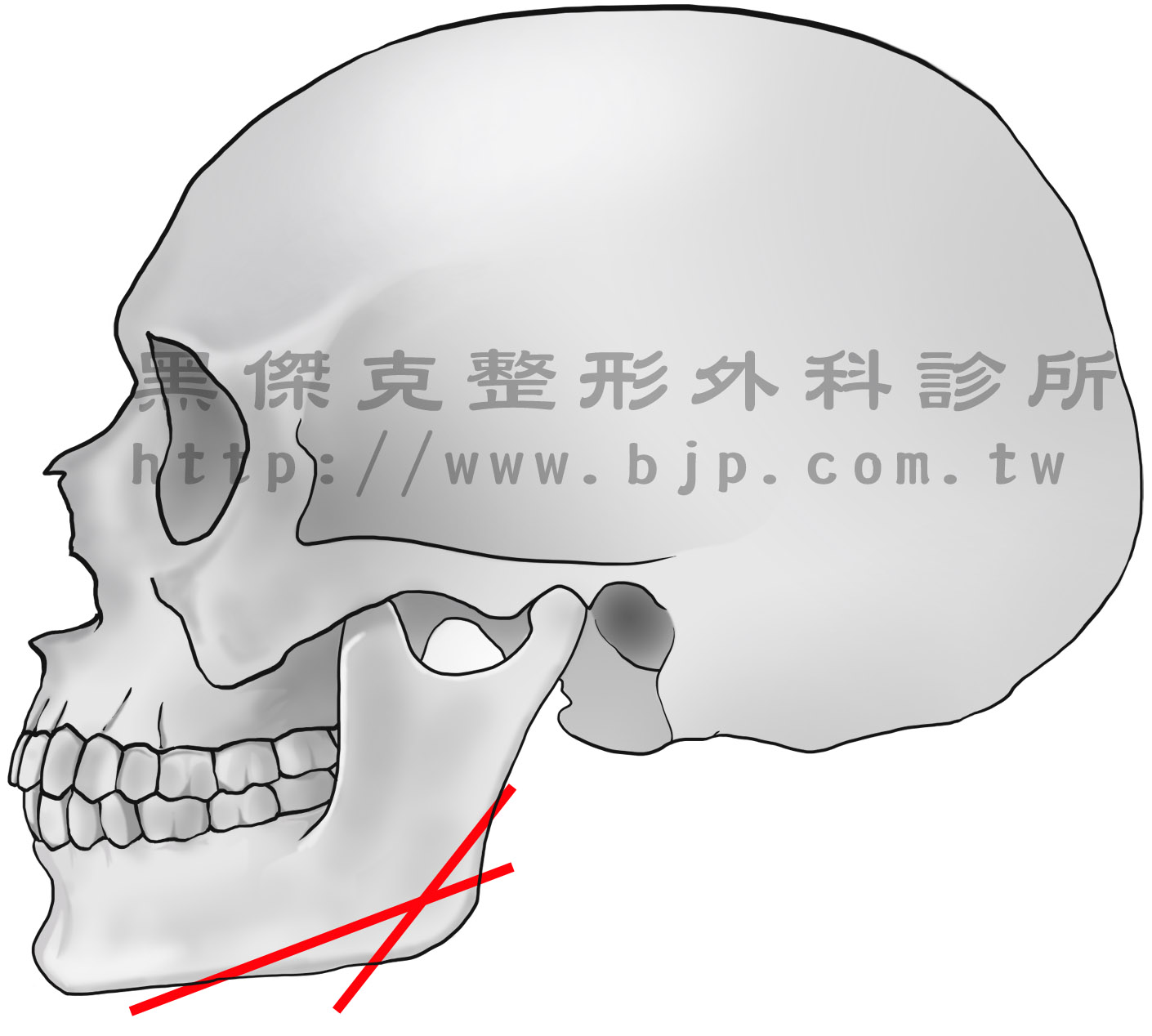 國字臉，通常經過手術切除下顎角後，咀嚼肌也會有部分萎縮的情形，使肌肉性的國字臉也一併得到改善。