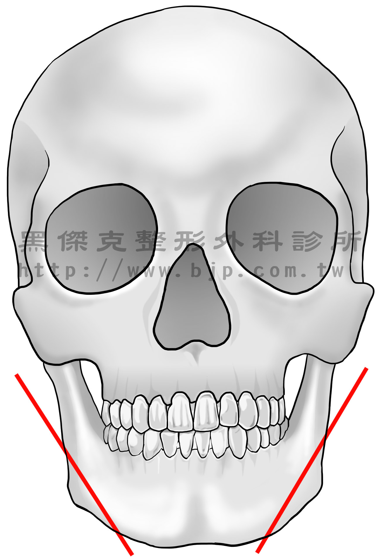 國字臉，手術從下牙齦兩側切開3~4公分的切口，然後將下頜骨轉角處剝離出來，把過於外凸的部分削除或磨除，再把較後凸、直角的骨頭切除，就不會再看到方形的骨頭突出，而轉角處就會呈現較圓滑的曲線，使下臉部的線條變得柔和。
