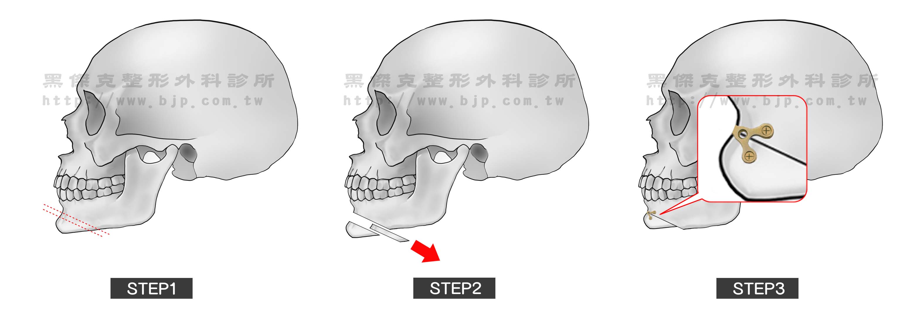下巴前凸手術，是從下牙齦旁做一切口，將下巴骨做橫向切開，將骨頭往後移並用骨釘及骨板固定，再將口腔黏膜縫合即完成。