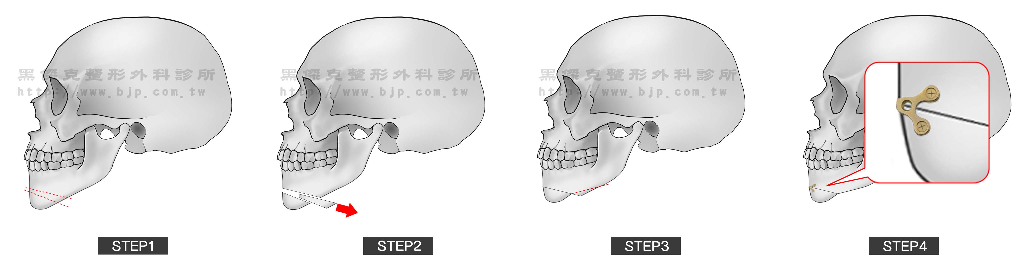 過長的下巴，就必須靠著下巴截骨手術，才有辦法將下巴截短。很常見的是合併有第三類咬合不良，或稱戽斗，這時就需要搭配齒顎矯正或正顎手術，才能有效改善臉型。