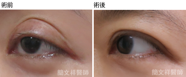 上眼皮褶痕下或褶痕上過於浮腫，透過重修手術補救，本院由整外經驗豐富的專業醫師為您解說