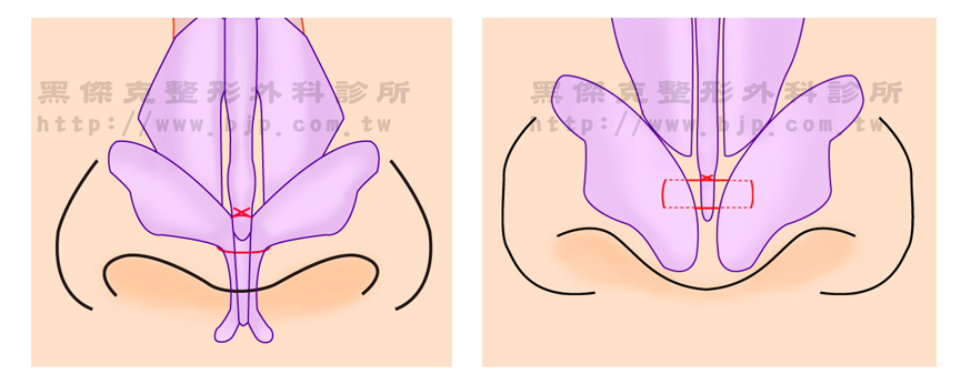 隆鼻重修手術時，因為手術區已有較多疤痕會導致手術較困難，有時也難達到最好的組織伸展情形。