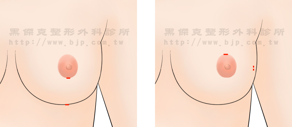 自體脂肪豐胸，自體脂肪豐胸療程對乳腺不會產生傷害，對生育、哺乳，亦沒有不良的影響。