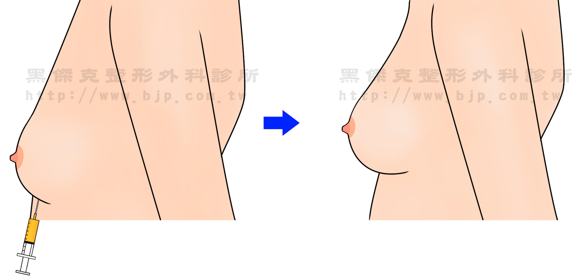 自體脂肪豐胸，自體脂肪移植後的乳房，柔軟，自然、真實。