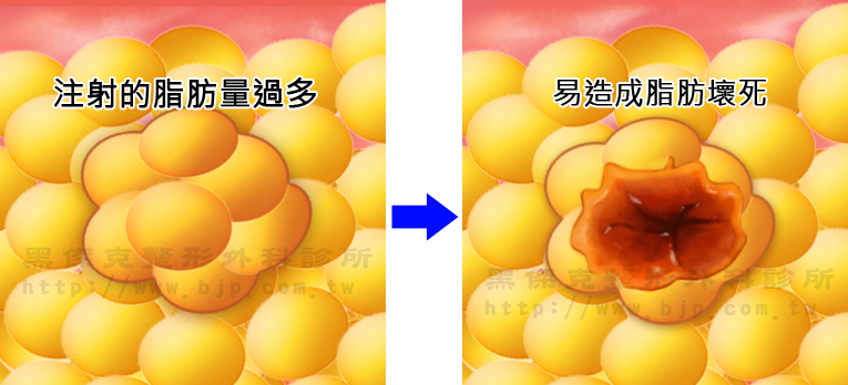 自體脂肪豐胸，對局部脂肪較多堆積的人，可豐胸定同時塑造沒好曲線，達到三圍雕塑的效果。