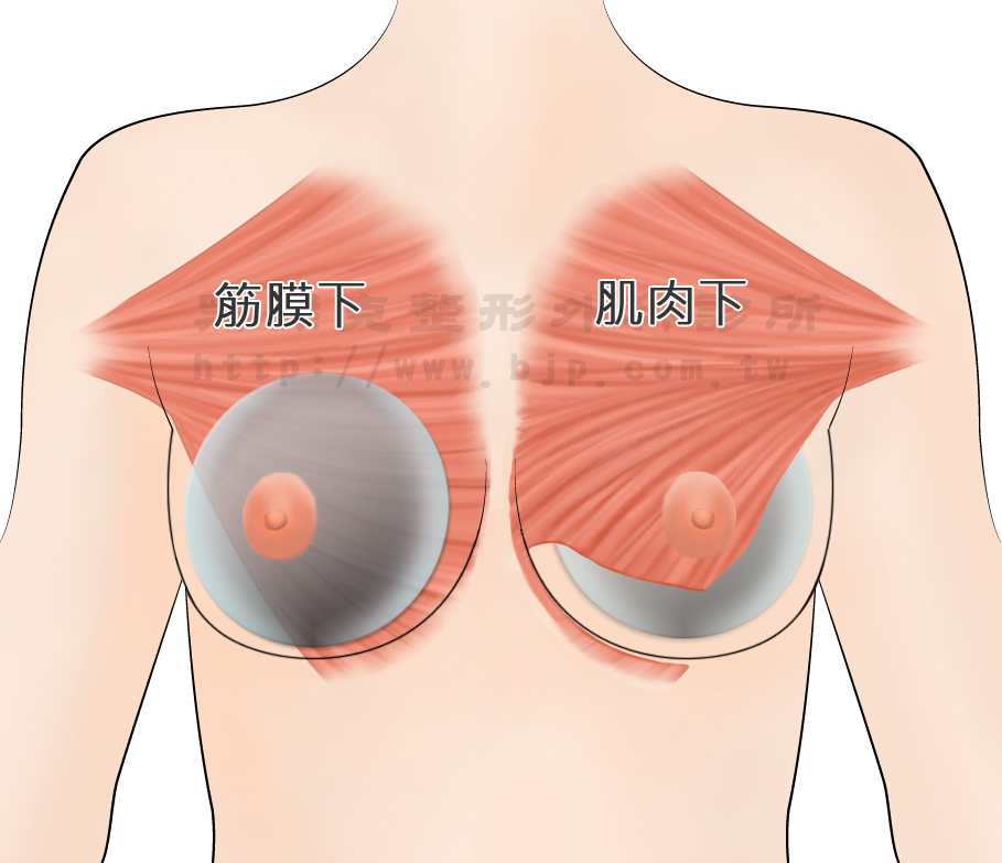 果凍矽膠隆乳，果凍矽膠置放的部位，可分成筋膜下方及胸大肌下方。義乳放置在不同的位置有不同的效果。
