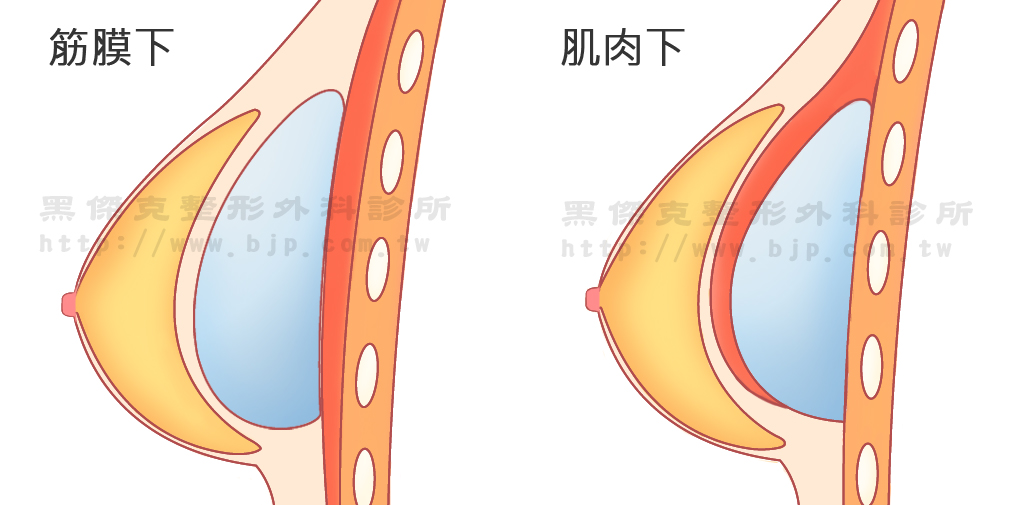 果凍矽膠隆乳，筋膜下 義乳置放於筋膜下疼痛感較低、較易擠出深乳溝、恢復時間快。適合乳腺較發達、皮下脂肪較厚實者。皮膚太薄的人，術後較容易看到或摸到義乳。