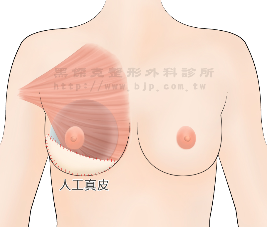 果凍矽膠隆乳，胸大肌下 義乳置放於胸大肌下疼痛感較高、較不易擠出深乳溝、恢復時間較慢。因有胸大肌的包覆，較能避免看到或摸到義乳，適合乳腺較不發達或胸部皮膚薄的者。