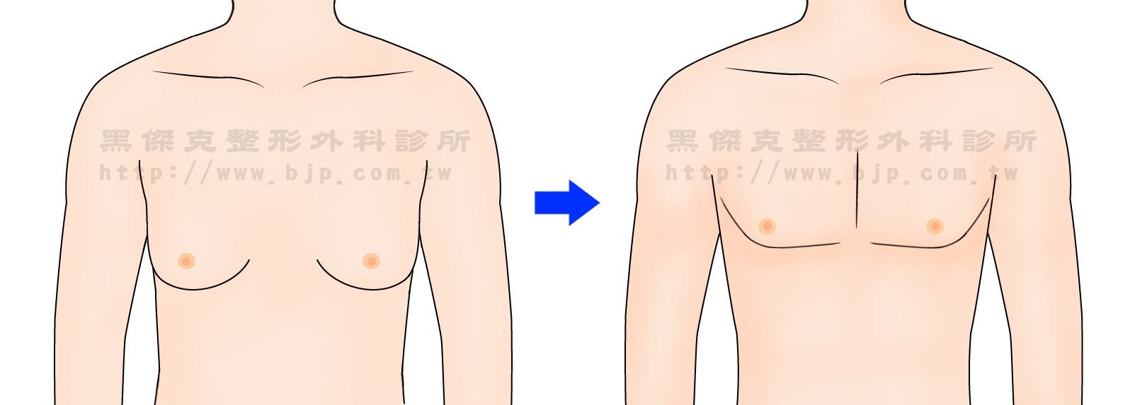 男性女乳症，抽脂：脂肪型或肥胖型的男性女乳症，主要是乳房的脂肪增生肥大，可把多餘的乳房脂肪抽掉。傷口小又能使乳房外觀變得較為平坦。