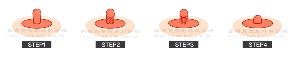 乳頭美型手術，乳頭過長：在乳頭底部周圍做一圈皮膚表淺層的環狀切除，再把上下兩端皮膚收緊縫合，即可有效縮短乳頭長度。