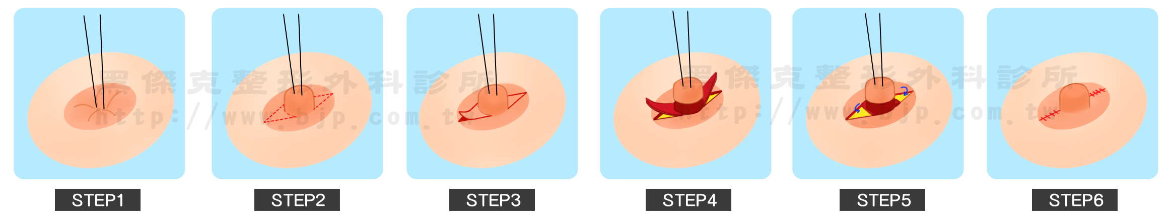 乳頭美型手術，乳頭凹陷：採用皮瓣支撐法來治療，將緊縮的乳頭下組織放鬆，消除乳頭向下牽引力量，再用2~3個乳暈皮瓣來做支撐。