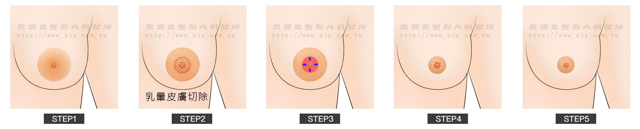 縮乳暈手術，內縮法：在乳暈與乳頭交接處，切除多餘的環形乳暈皮膚，再向內縫合，術後疤痕較不明顯，缺點是改善的範圍不大，乳暈過大者，可能需要分階段進行。