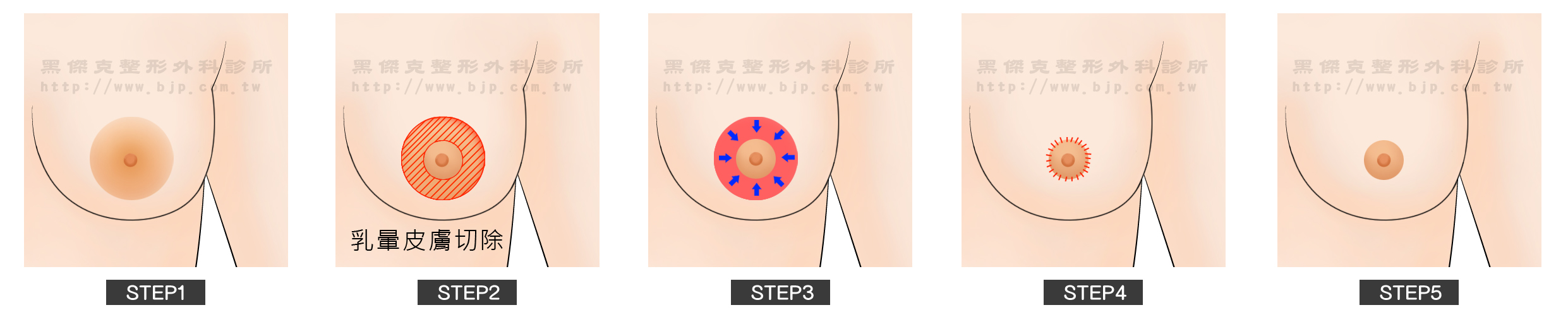 縮乳暈手術，外縮法：在乳暈外緣與正常皮膚交接處，將多餘的乳暈皮膚以同心圓方式切除再縫合，初期會有乳暈皺褶（暫時），之後會隨著時間而平整。