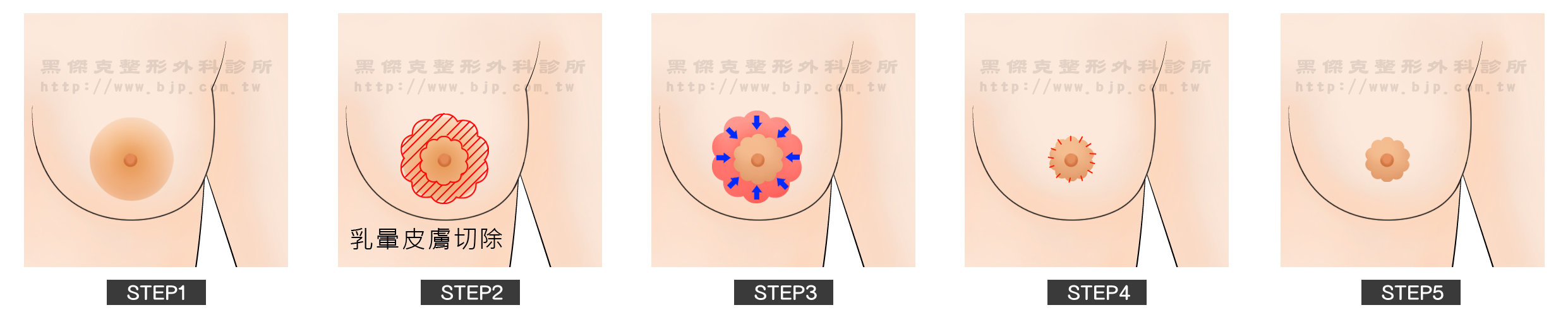 縮乳暈手術，外縮法：與內縮法比較的優點是切除的範圍較大、改善較多，缺點是乳暈周圍可能會有淡色疤痕。