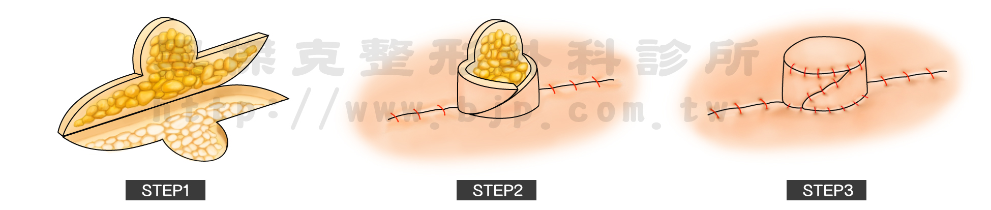 乳頭重建，局部皮瓣手術，在重建的乳房皮膚上做出旋轉皮瓣，像折紙一樣，把平面的紙折起來，讓凸起的地方變成新乳頭的形狀，創造出新的乳頭，優點是無需破壞對側乳頭