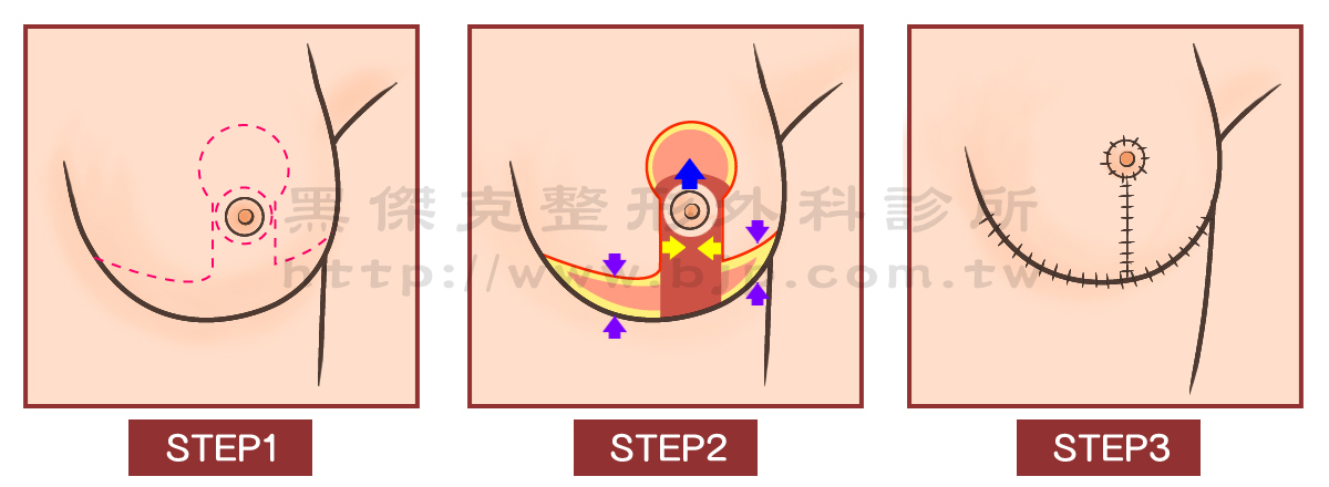 標準縮乳手術，這是可靠且通用的縮乳方法，從很大的乳房到中型的乳房都適用，將多餘的皮膚及乳腺切除，能有效的縮小乳房，並重新安置乳暈和乳頭位置，可同時有提乳的效果，術後胸部形狀會變得較堅挺。