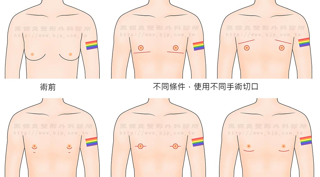 垂直切口縮乳手術，手術切口位於乳暈一圈及乳暈下垂直一條，就像棒棒糖的形狀，將多餘的皮膚及乳腺切除，並重新安置乳暈和乳頭位置，可有提乳的效果，術後胸部形狀會變得較堅挺。