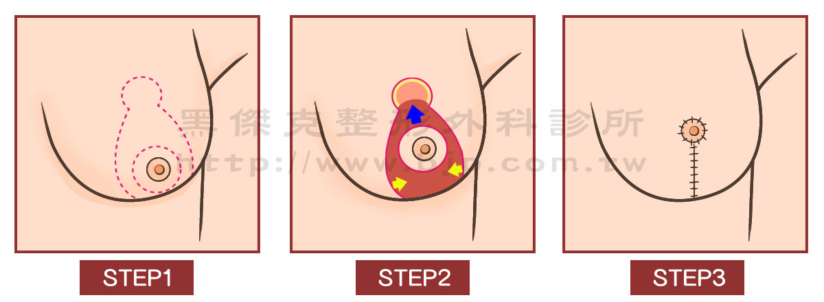 提乳手術，乳房下垂，必須藉由提乳手術來矯正，其中以環狀切口提乳手術（甜甜圈提乳法），較受女性接受