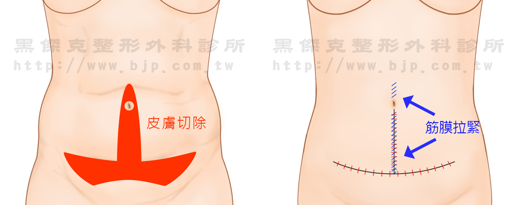 上下腹部拉皮，將鬆弛的腹部肌肉和筋膜拉緊，切除過多鬆弛的皮膚與妊娠紋，再將肚臍移位重整。