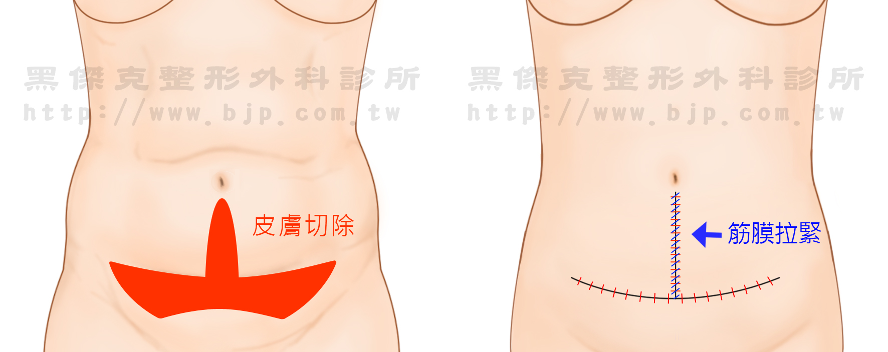下腹部拉皮，可利用剖腹產的傷口來做，減少疤痕的產生。通常會放置引流管，可避免血水或體液屯積。